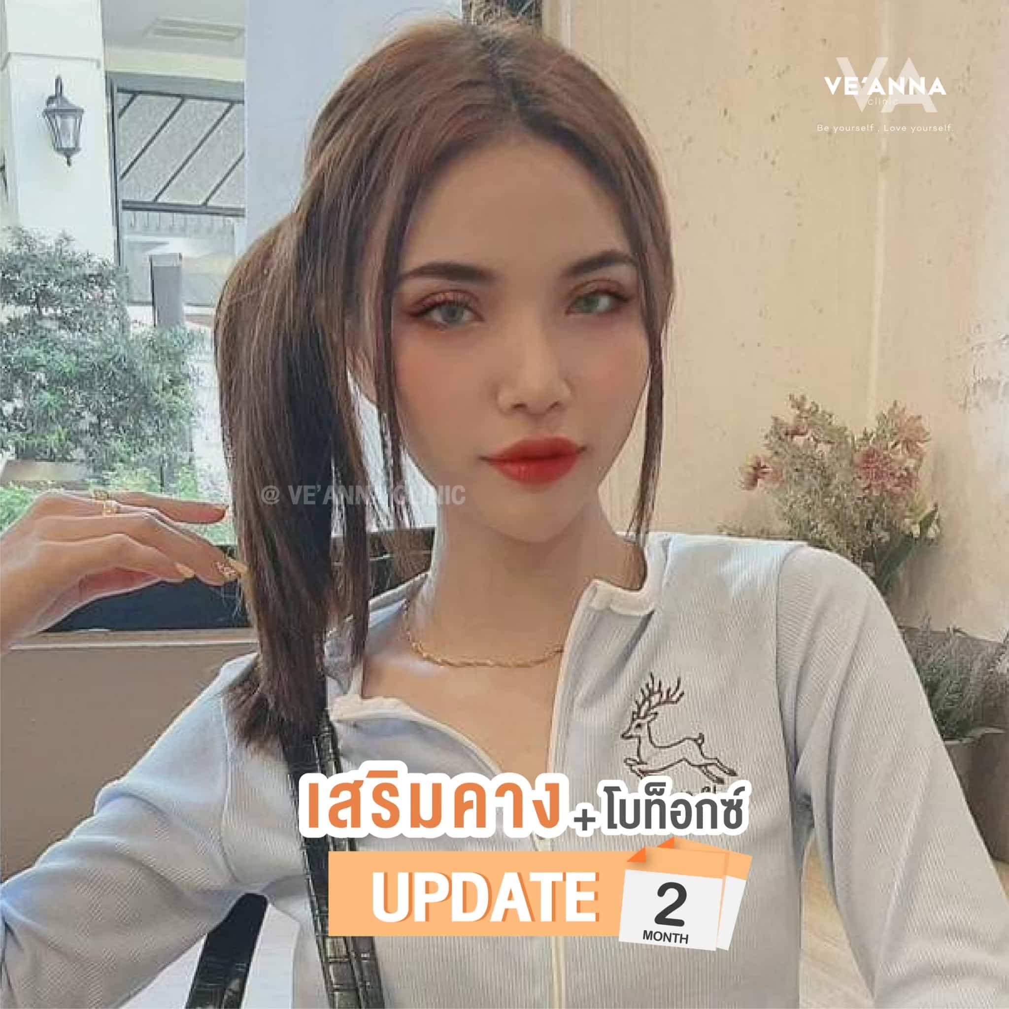 รีวิวการเสริมคางแผลใน Double V