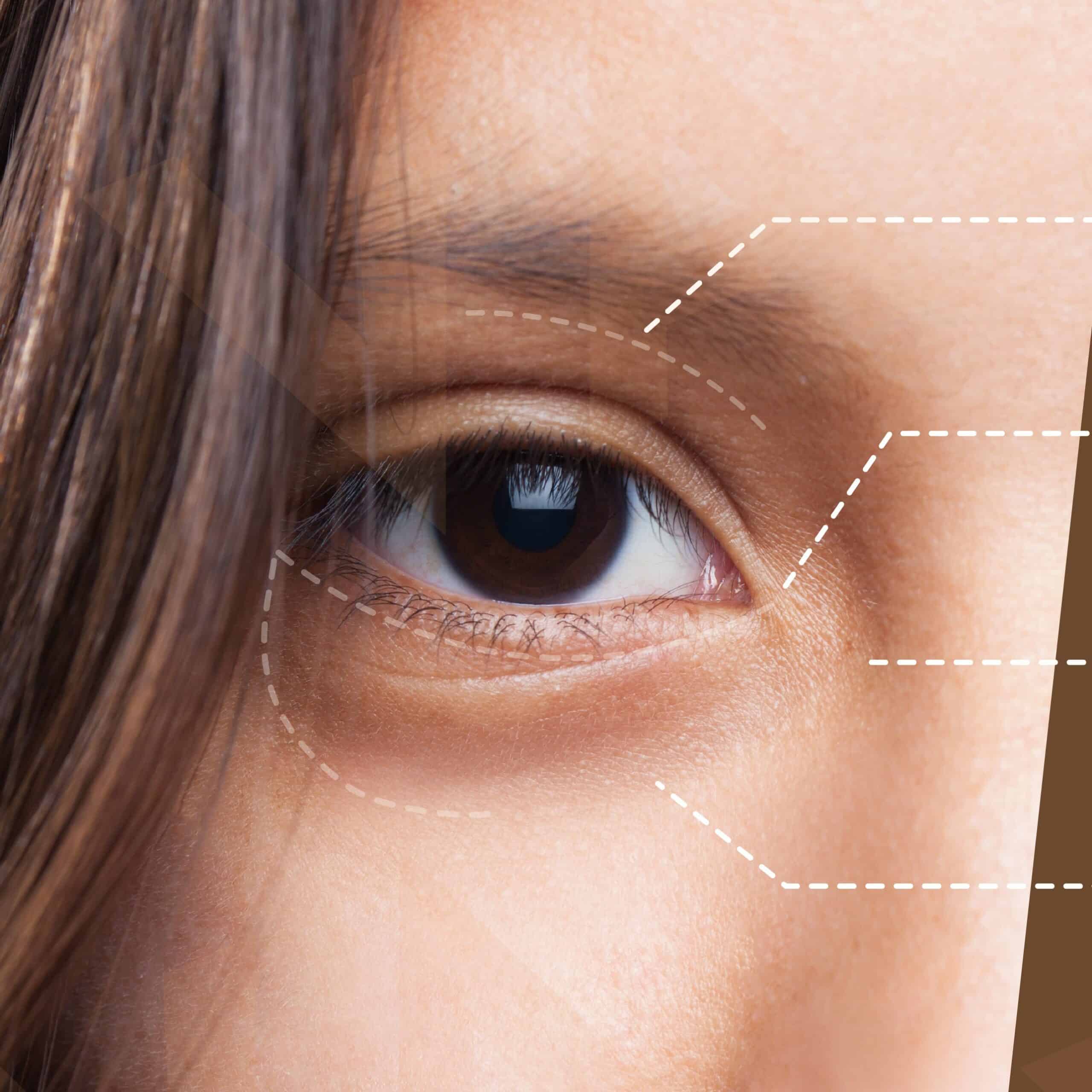 ฟิลเลอร์ใต้ตา ดีจริงหรือหลอก หมอป๊อปมีคำตอบ!