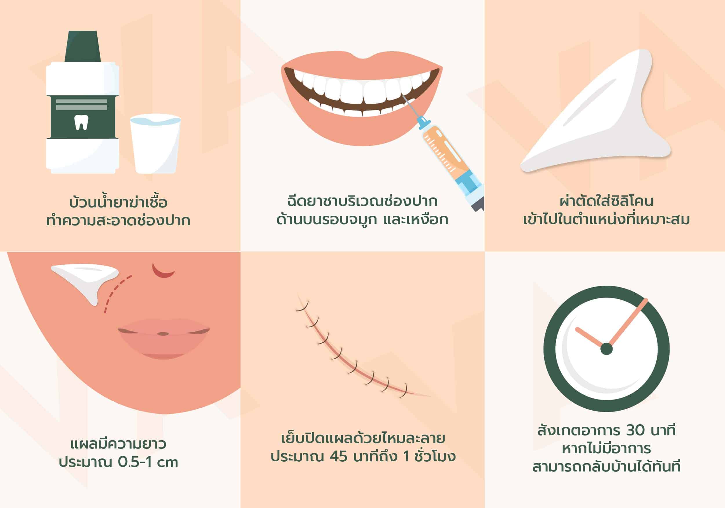 เสริมร่องแก้มด้วยซิลิโคน บอกลาปัญหาร่องแก้มลึกถาวร