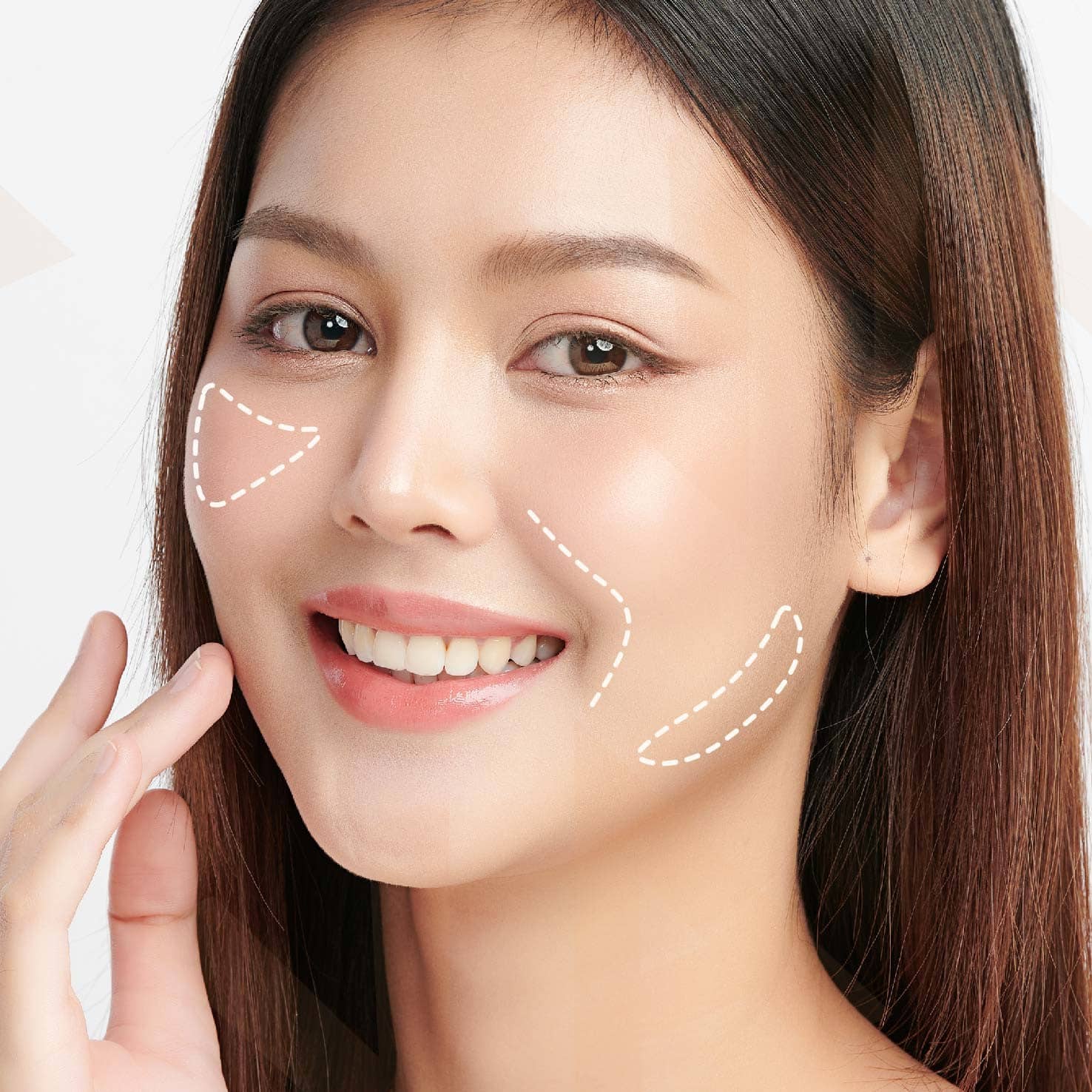 เสริมร่องแก้ม ด้วยซิลิโคน บอกลาปัญหาร่องแก้มลึกถาวร