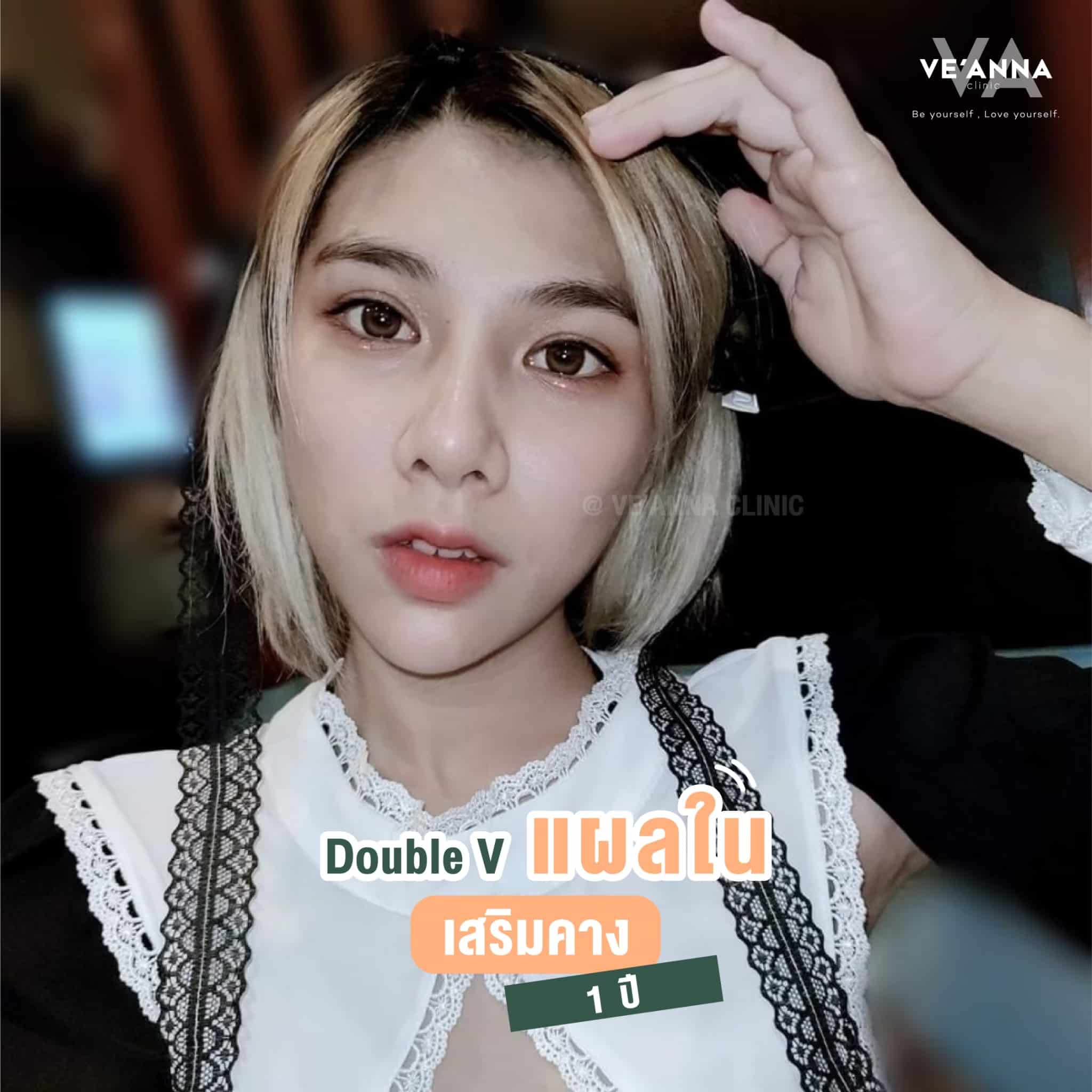 รีวิวการเสริมคางแผลใน Double V