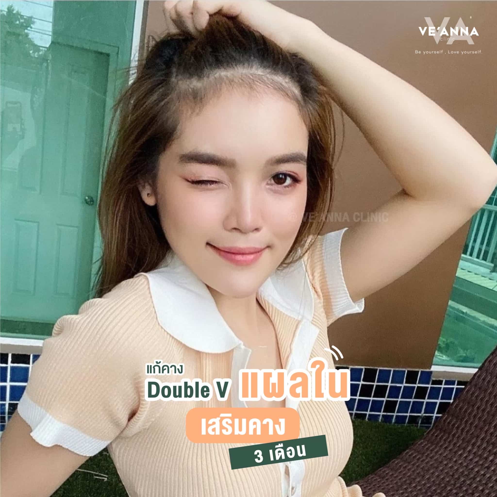 รีวิวการเสริมคางแผลใน Double V