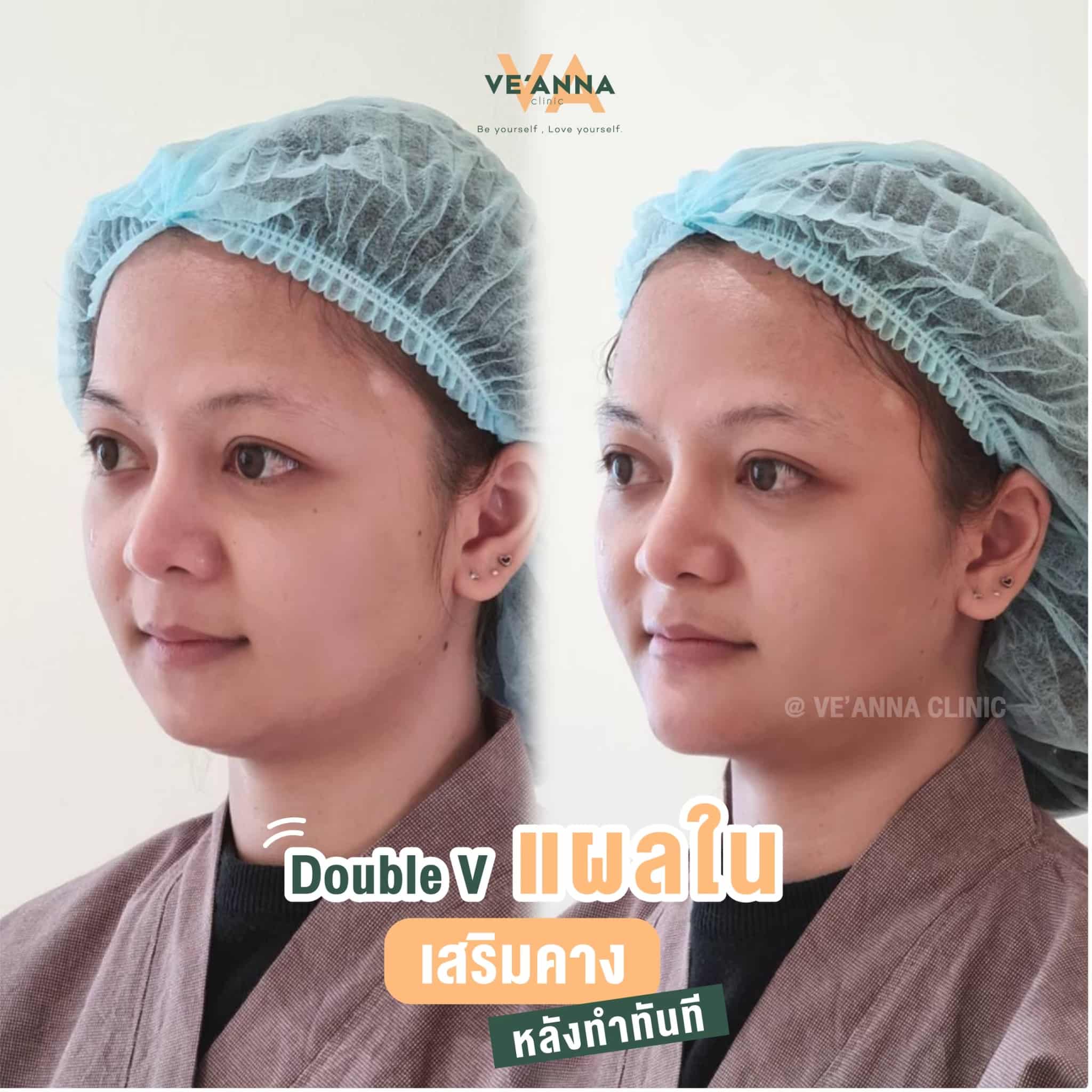 รีวิวการเสริมคางแผลใน Double V