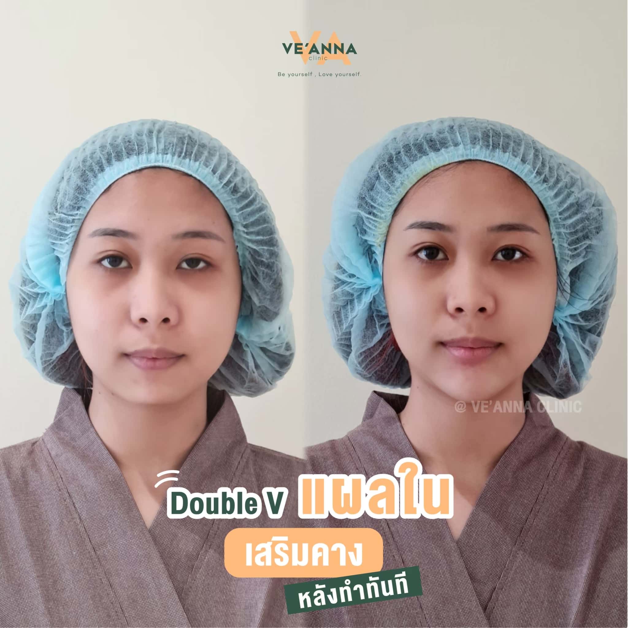 รีวิวการเสริมคางแผลใน Double V