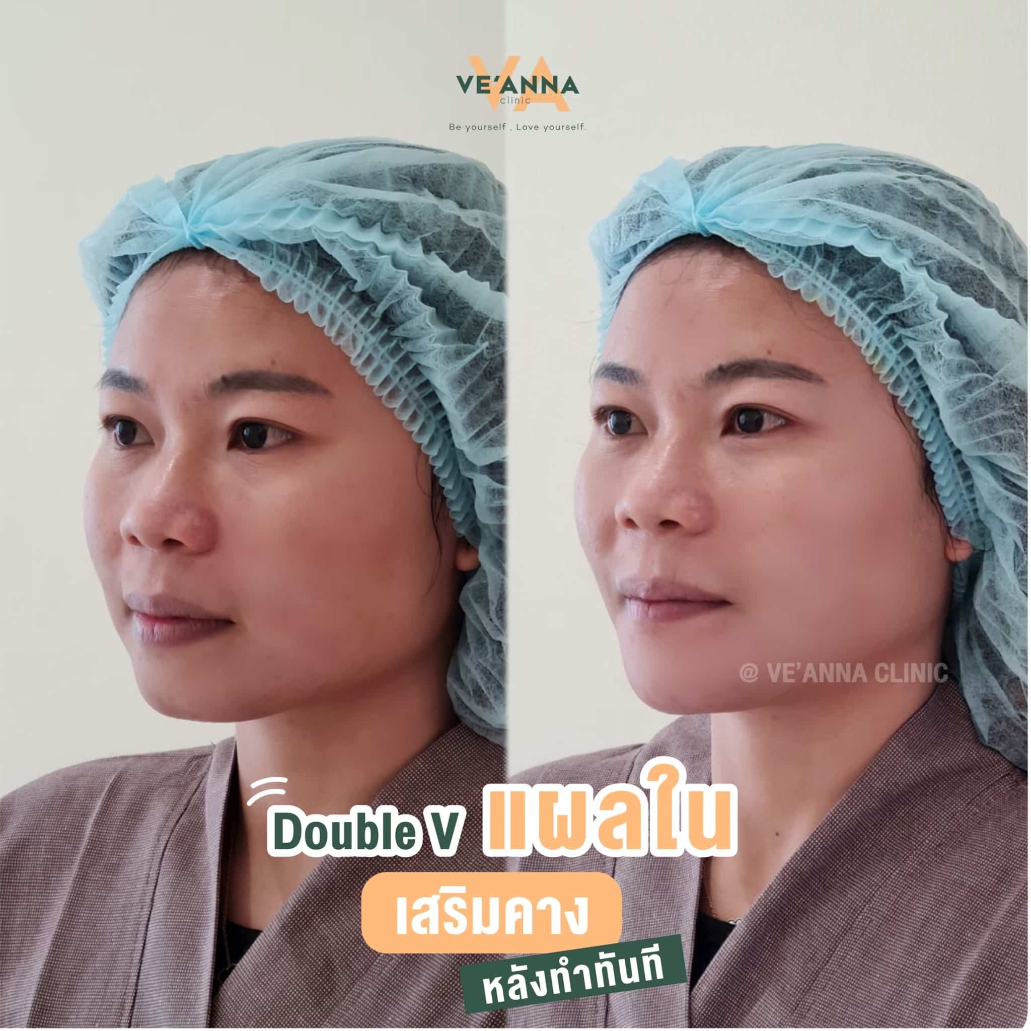 รีวิวการเสริมคางแผลใน Double V