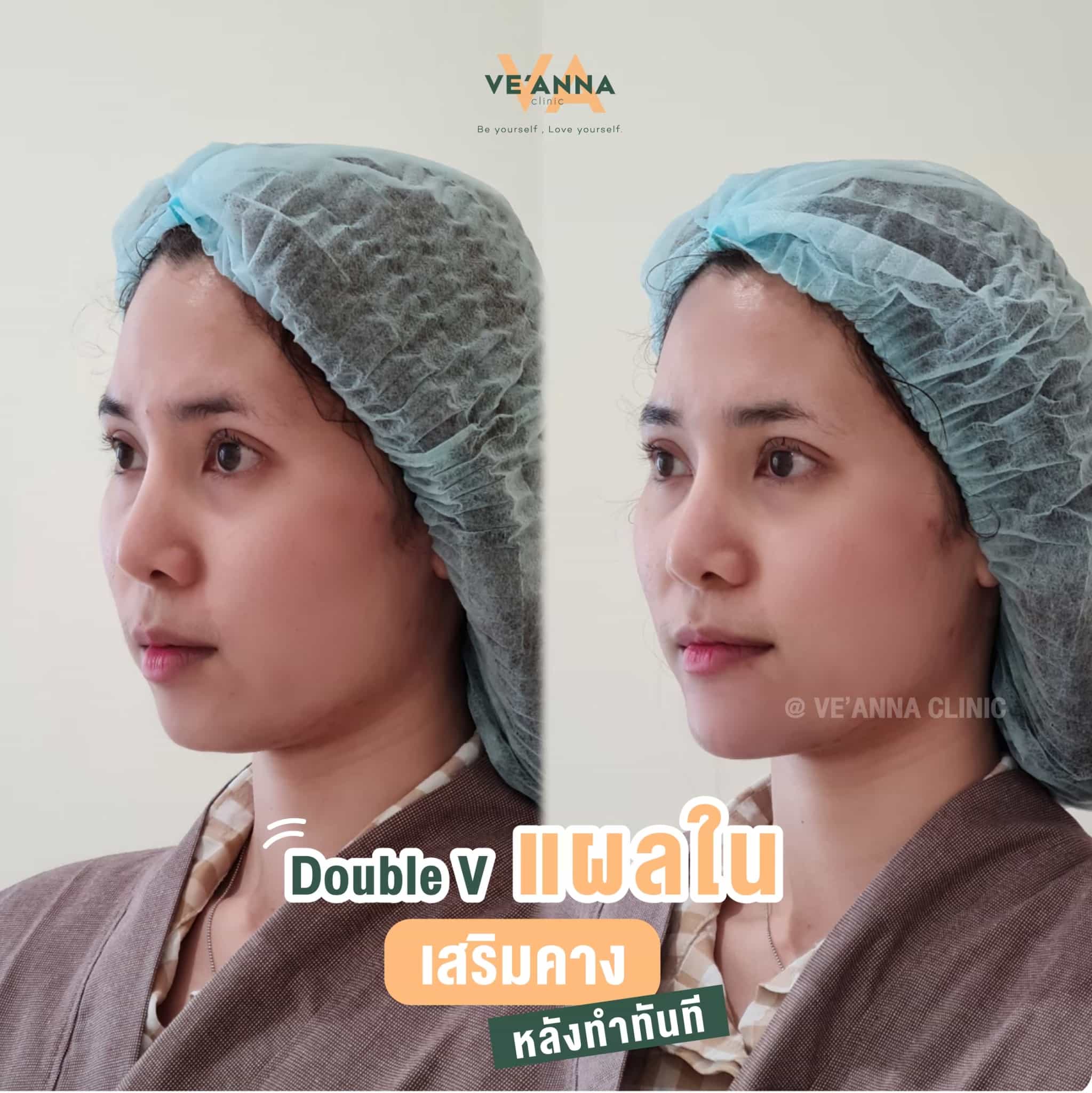 รีวิวการเสริมคางแผลใน Double V