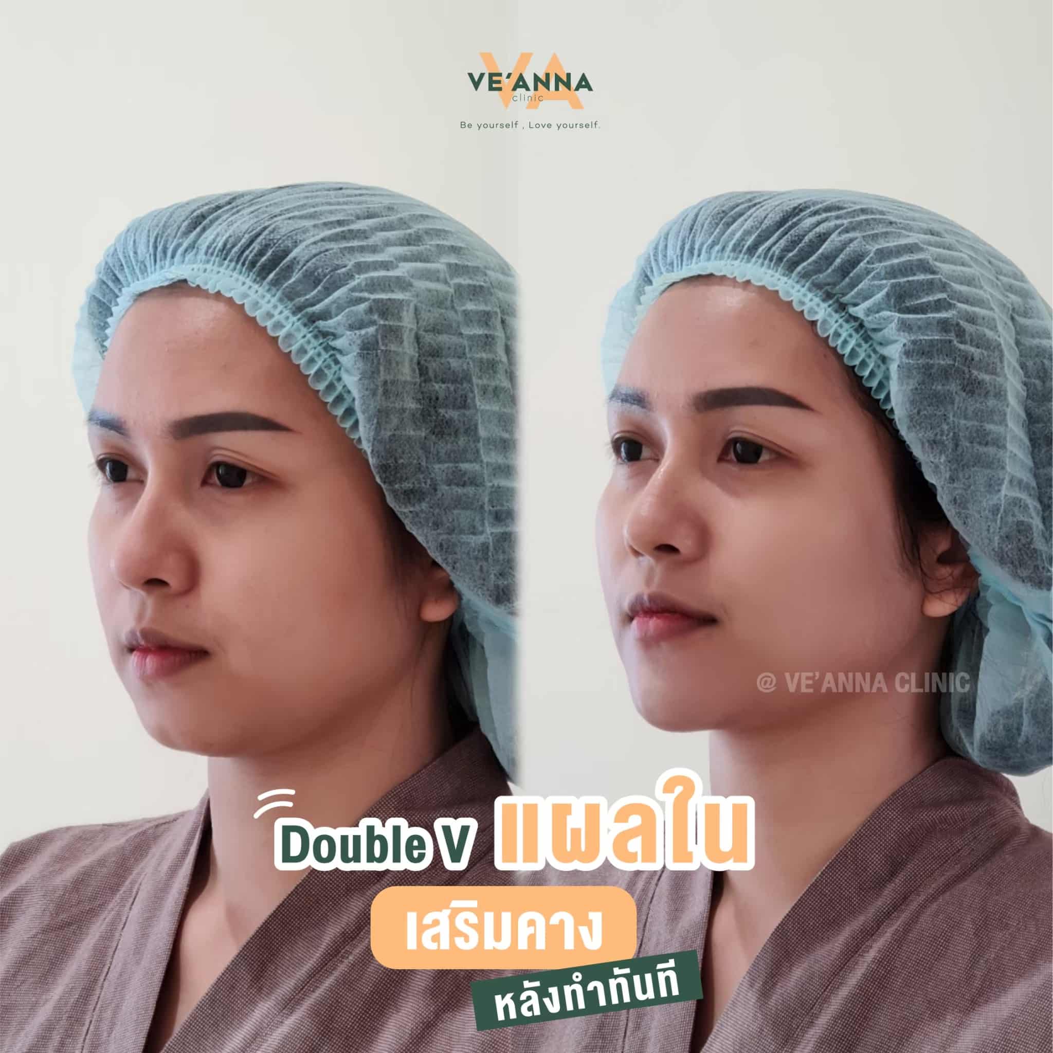 รีวิวการเสริมคางแผลใน Double V