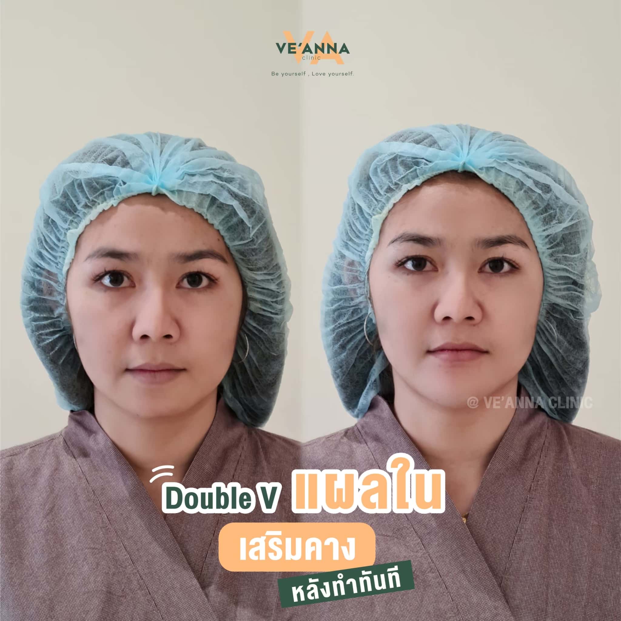 รีวิวการเสริมคางแผลใน Double V