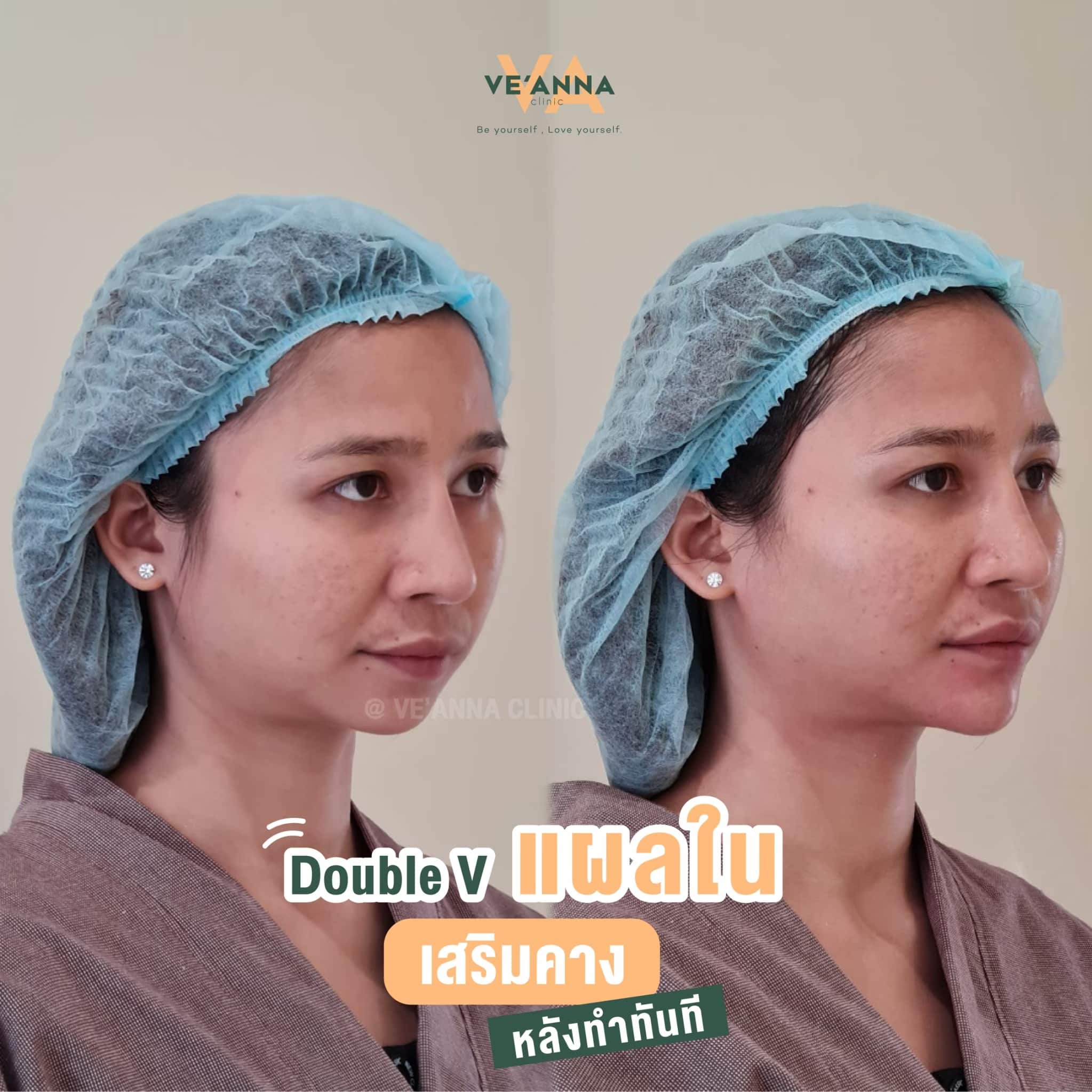 รีวิวการเสริมคางแผลใน Double V