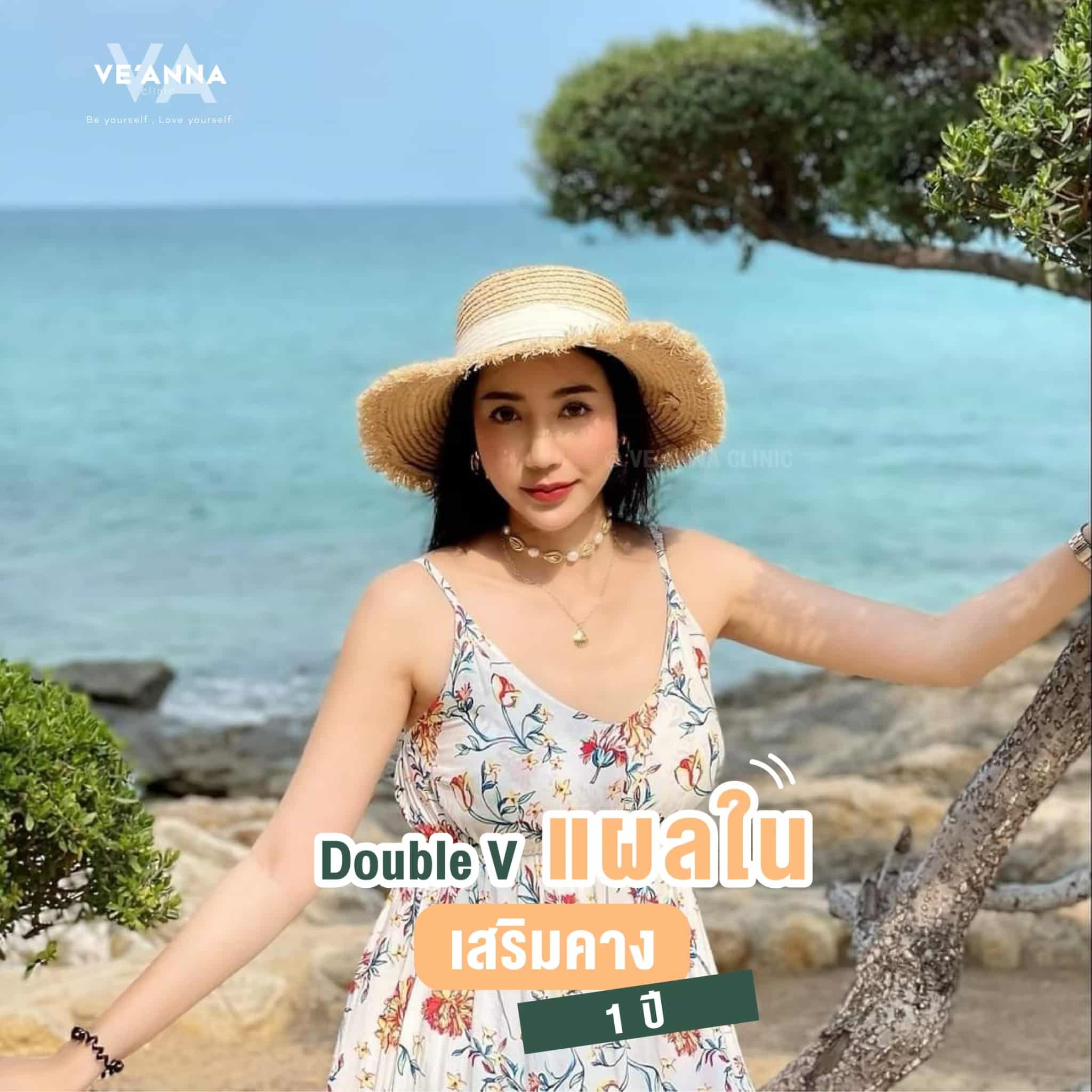 รีวิวการเสริมคางแผลใน Double V