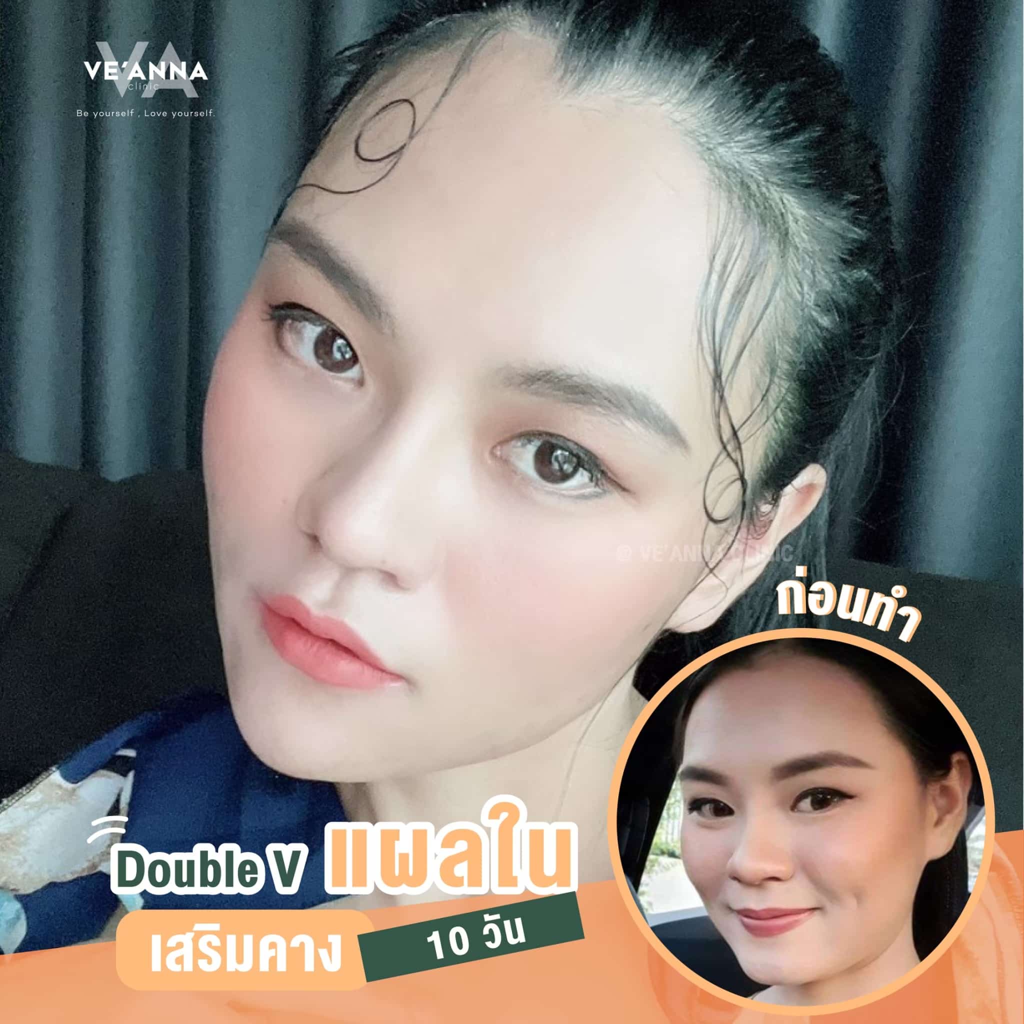 รีวิวการเสริมคางแผลใน Double V