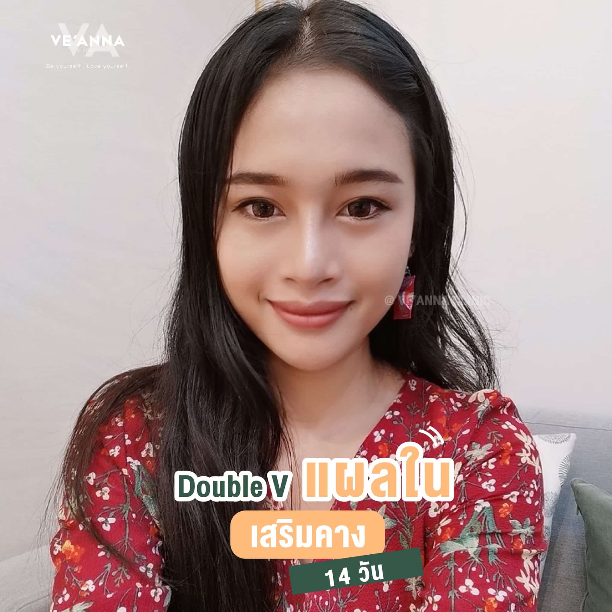 รีวิวการเสริมคางแผลใน Double V