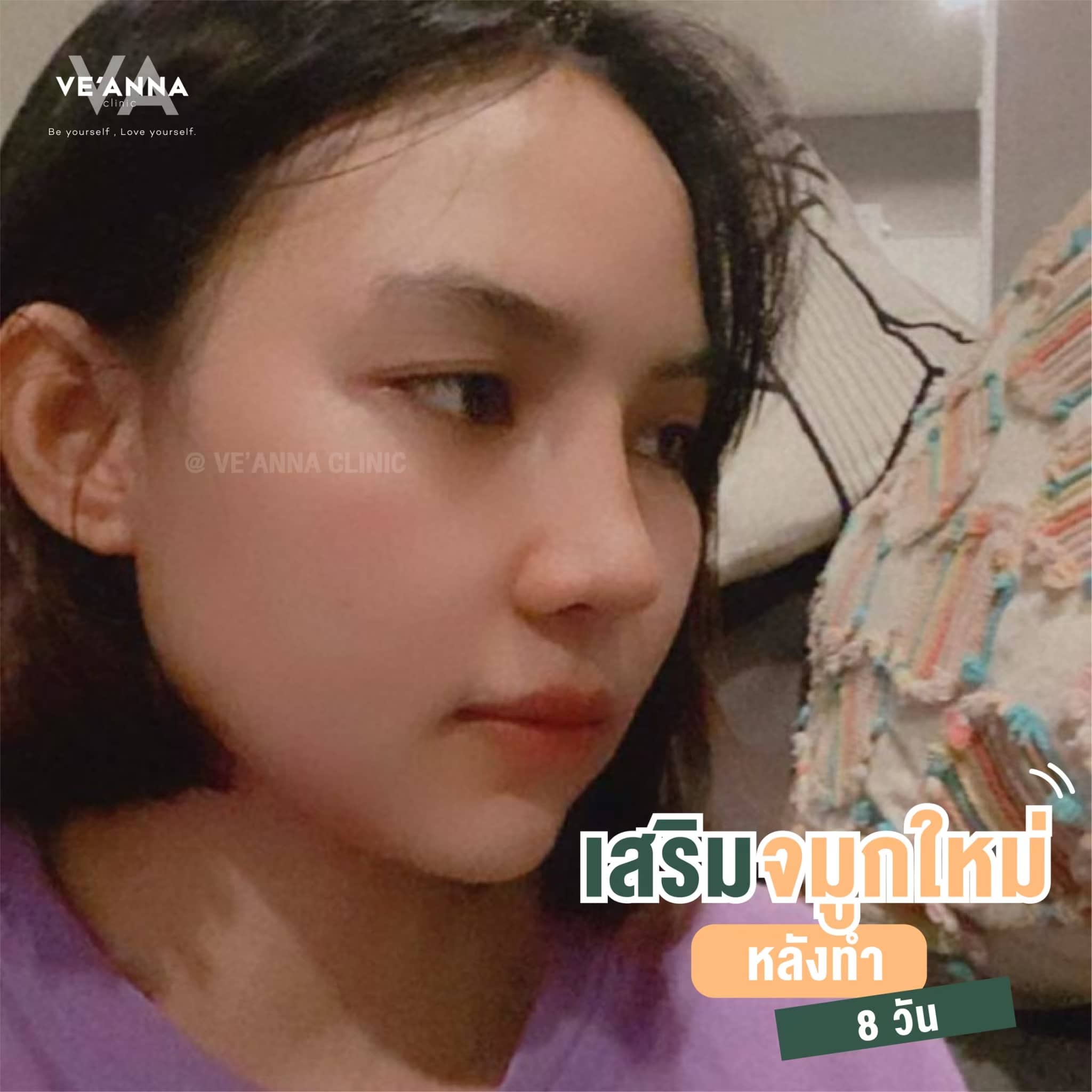 รีวิวการเสริมจมูก อินเตอร์โดม เนื้อเยื่อเทียม
