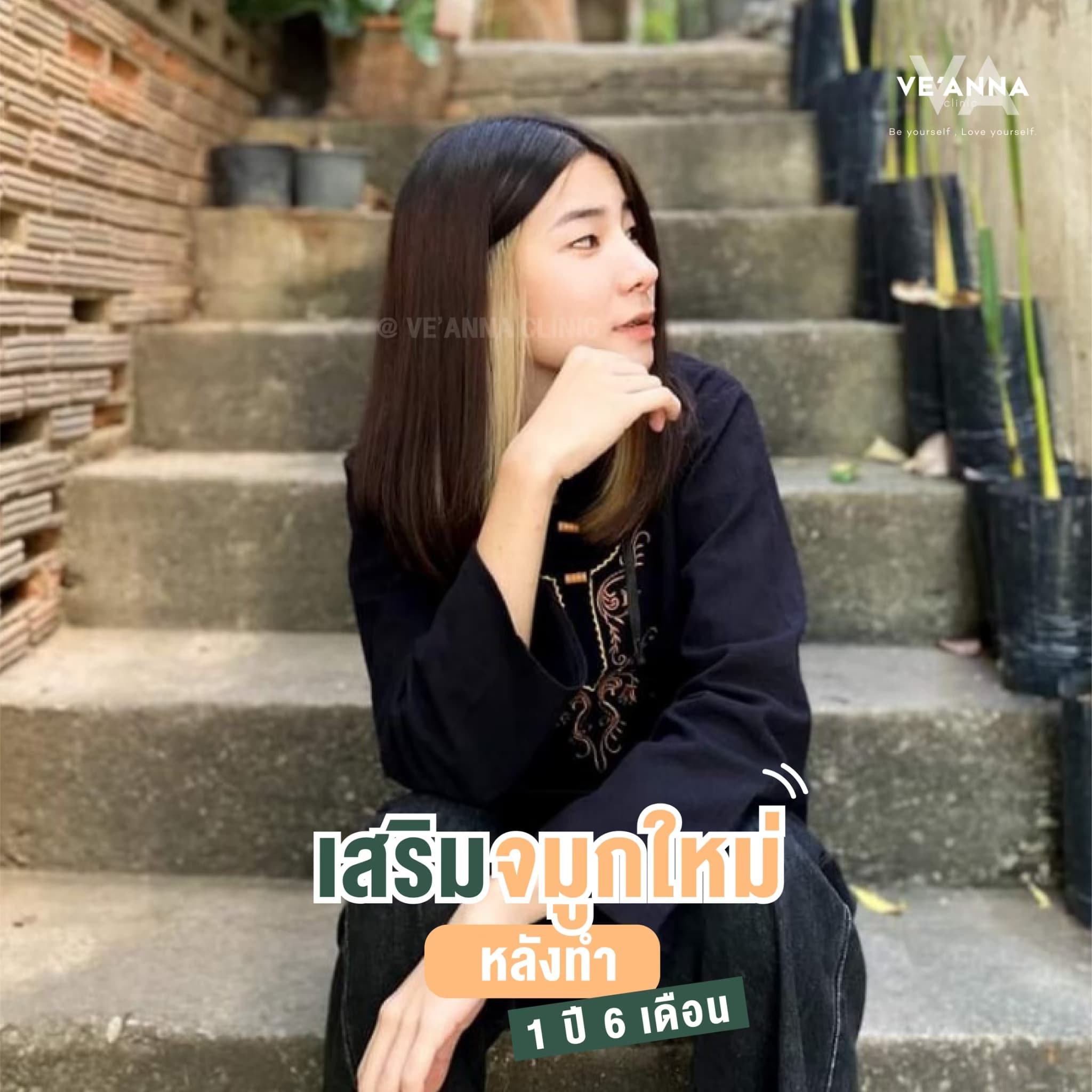 รีวิวการเสริมจมูก อินเตอร์โดม เนื้อเยื่อเทียม