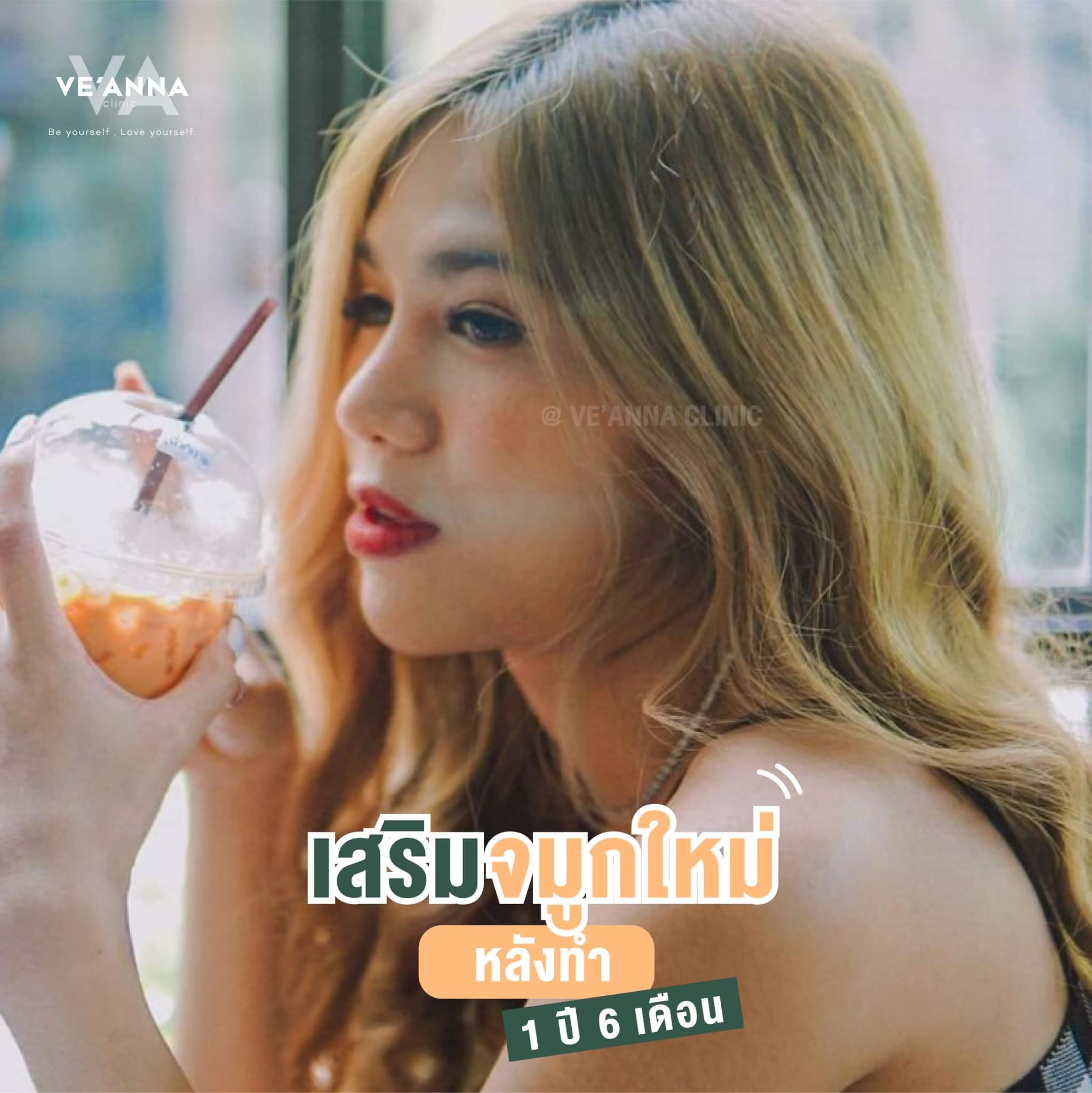 รีวิวการเสริมจมูก อินเตอร์โดม เนื้อเยื่อเทียม