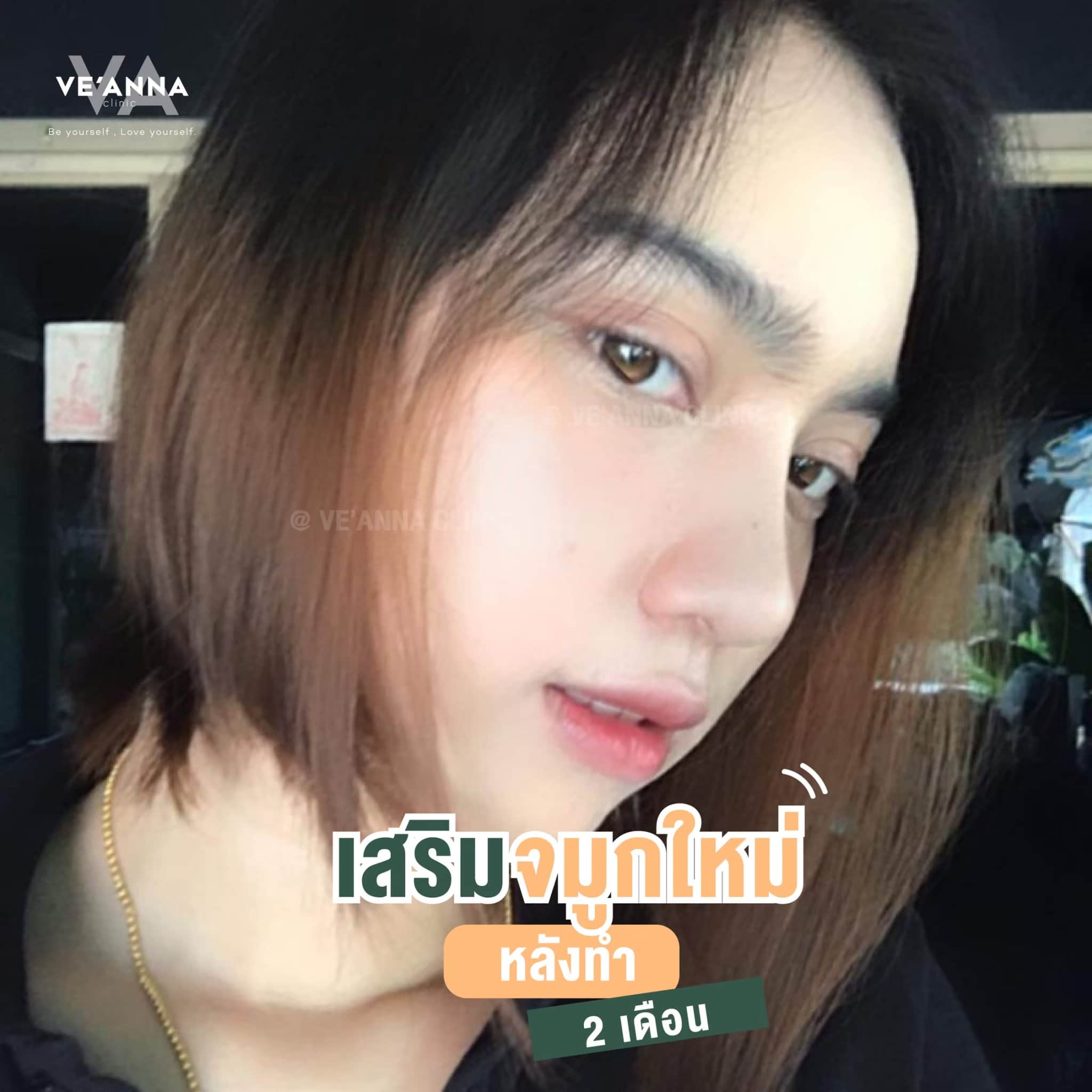 รีวิวการเสริมจมูก อินเตอร์โดม เนื้อเยื่อเทียม