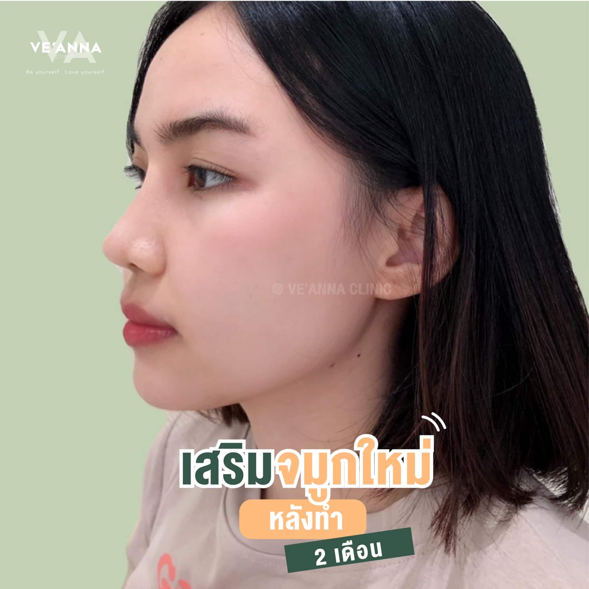 รีวิวการเสริมจมูก อินเตอร์โดม เนื้อเยื่อเทียม