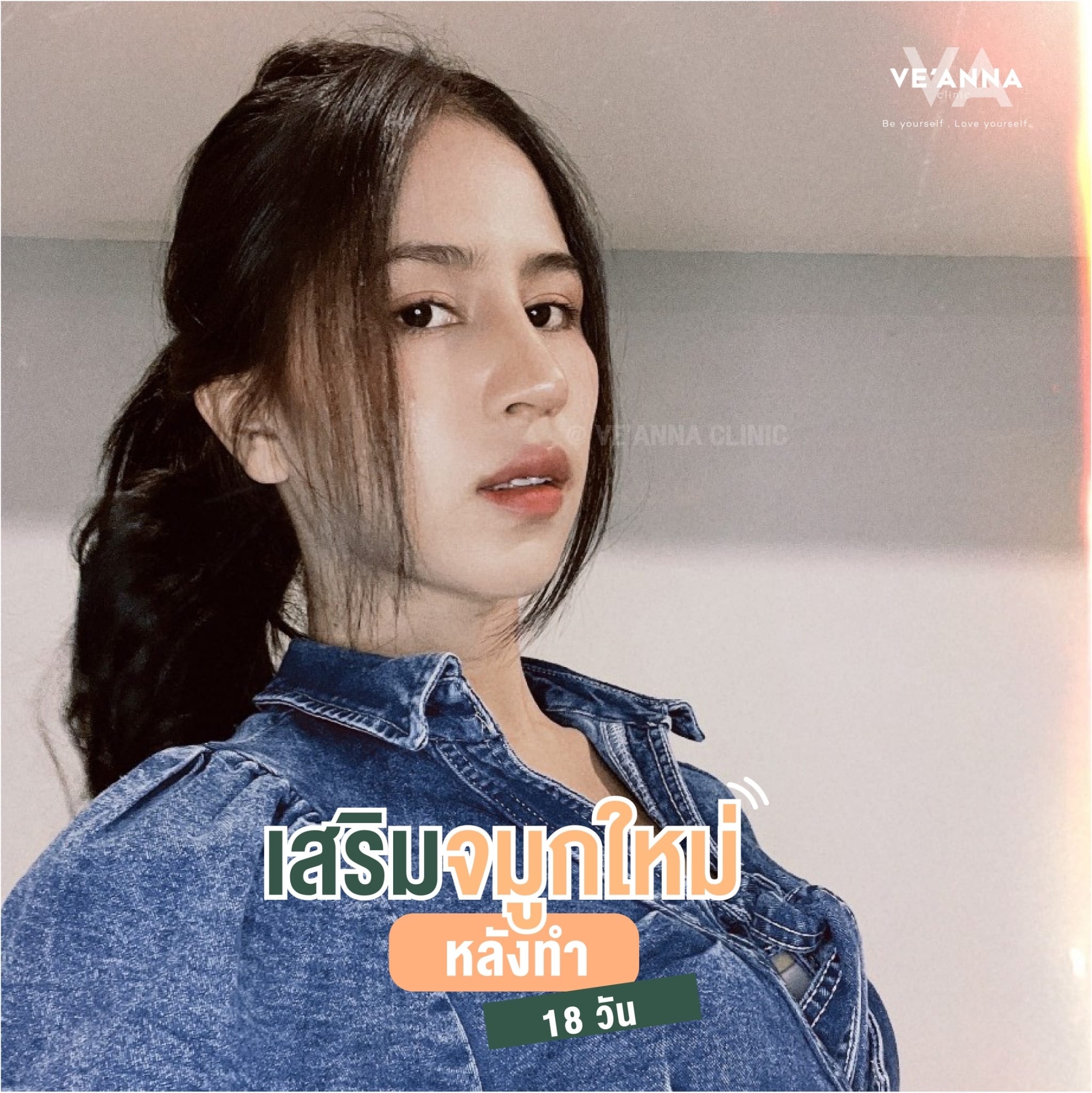 รีวิวการเสริมจมูก อินเตอร์โดม เนื้อเยื่อเทียม