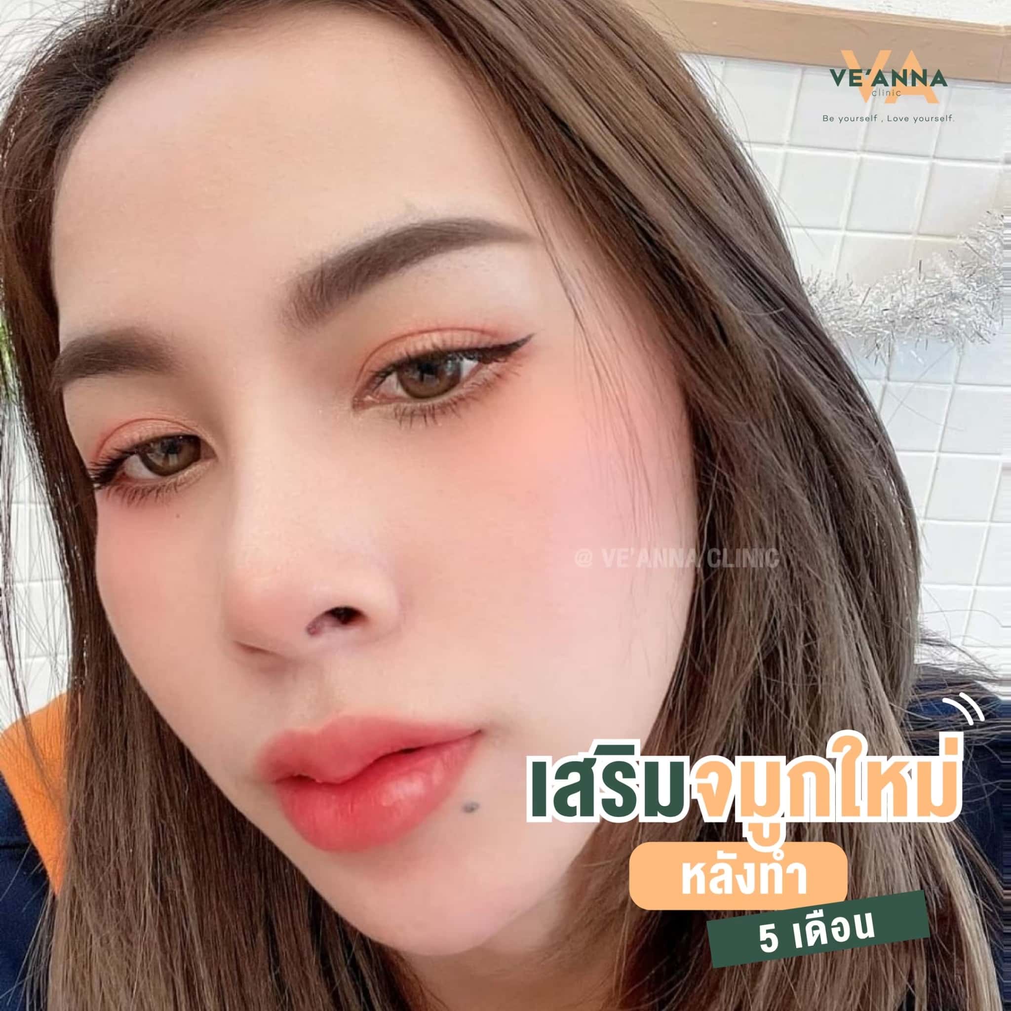 รีวิวการเสริมจมูก อินเตอร์โดม เนื้อเยื่อเทียม