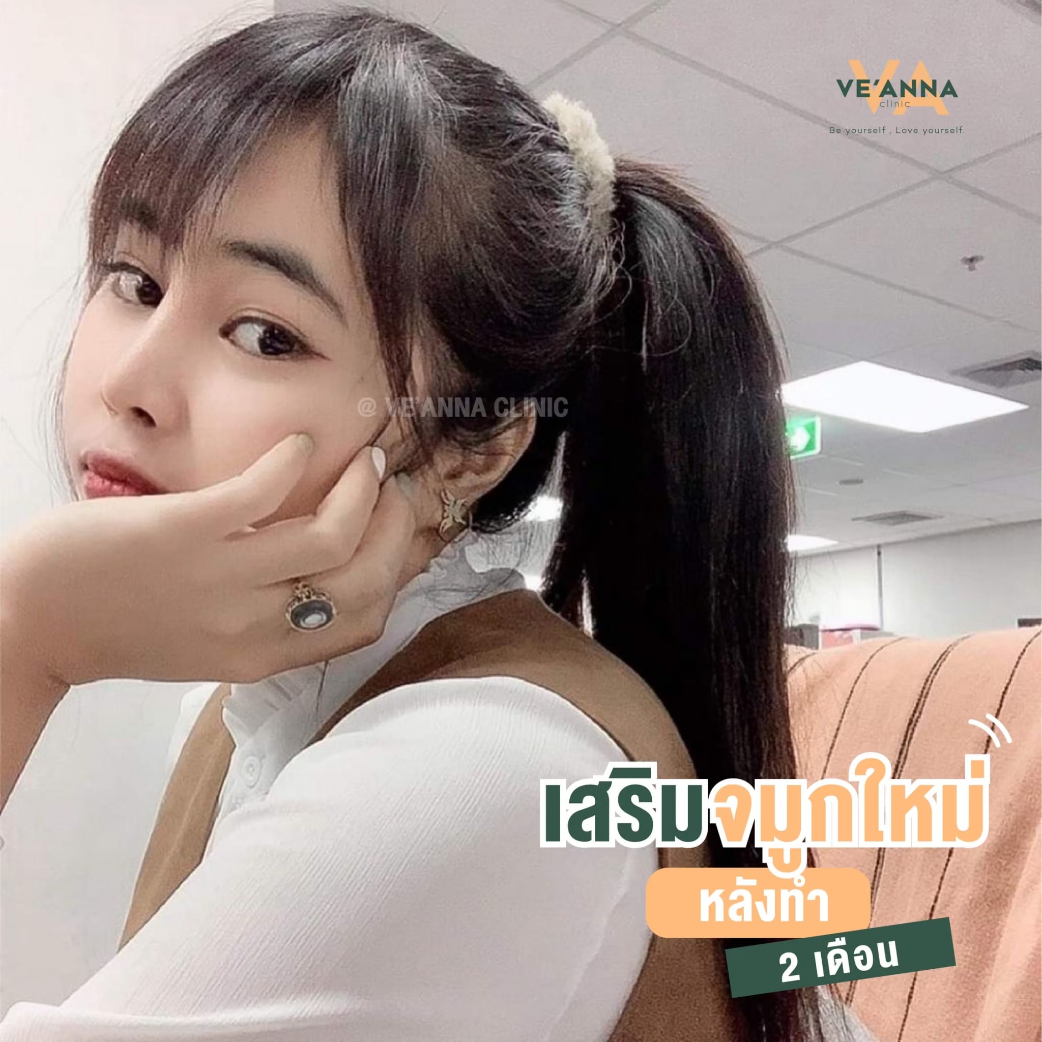 รีวิวการเสริมจมูก อินเตอร์โดม เนื้อเยื่อเทียม