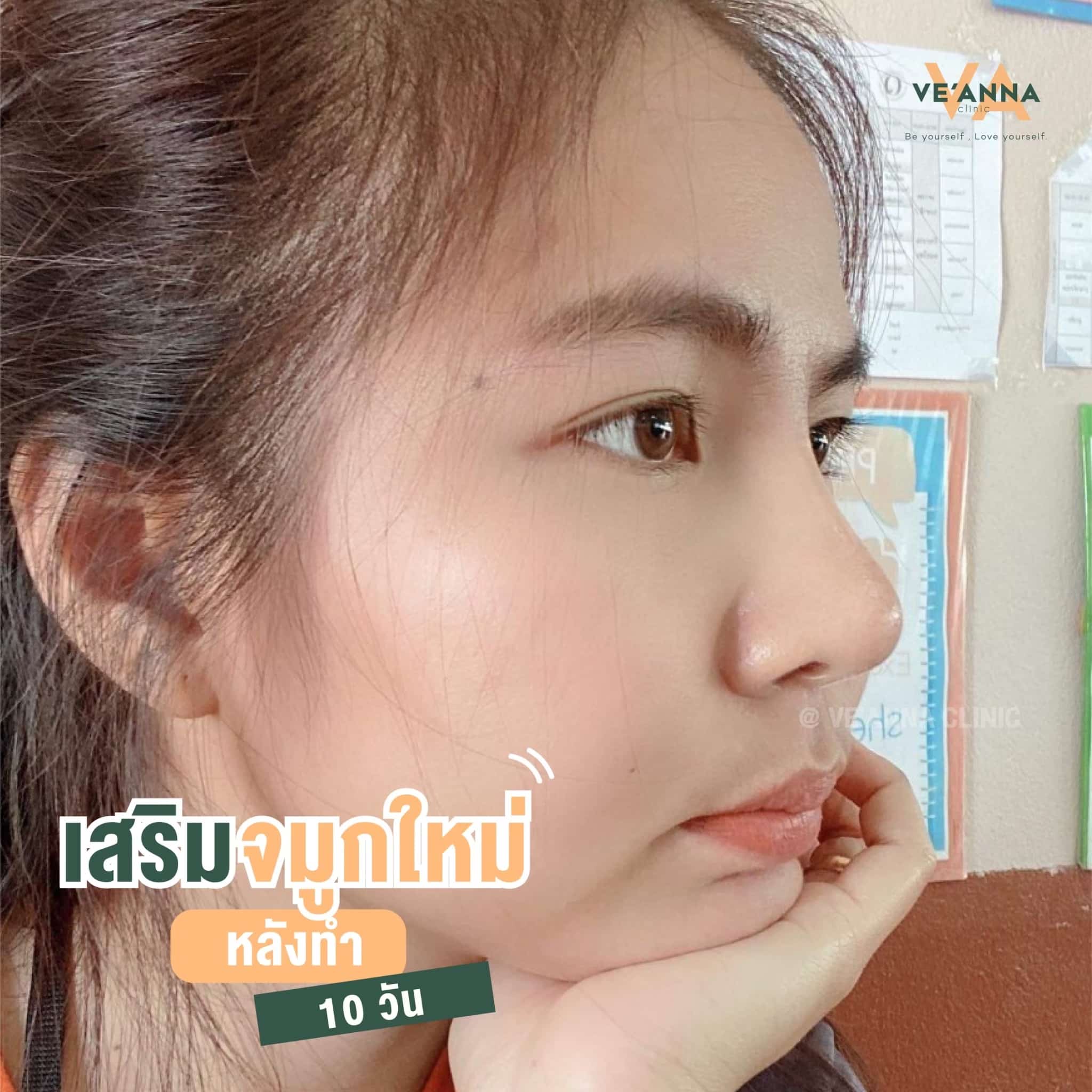 รีวิวการเสริมจมูก อินเตอร์โดม เนื้อเยื่อเทียม