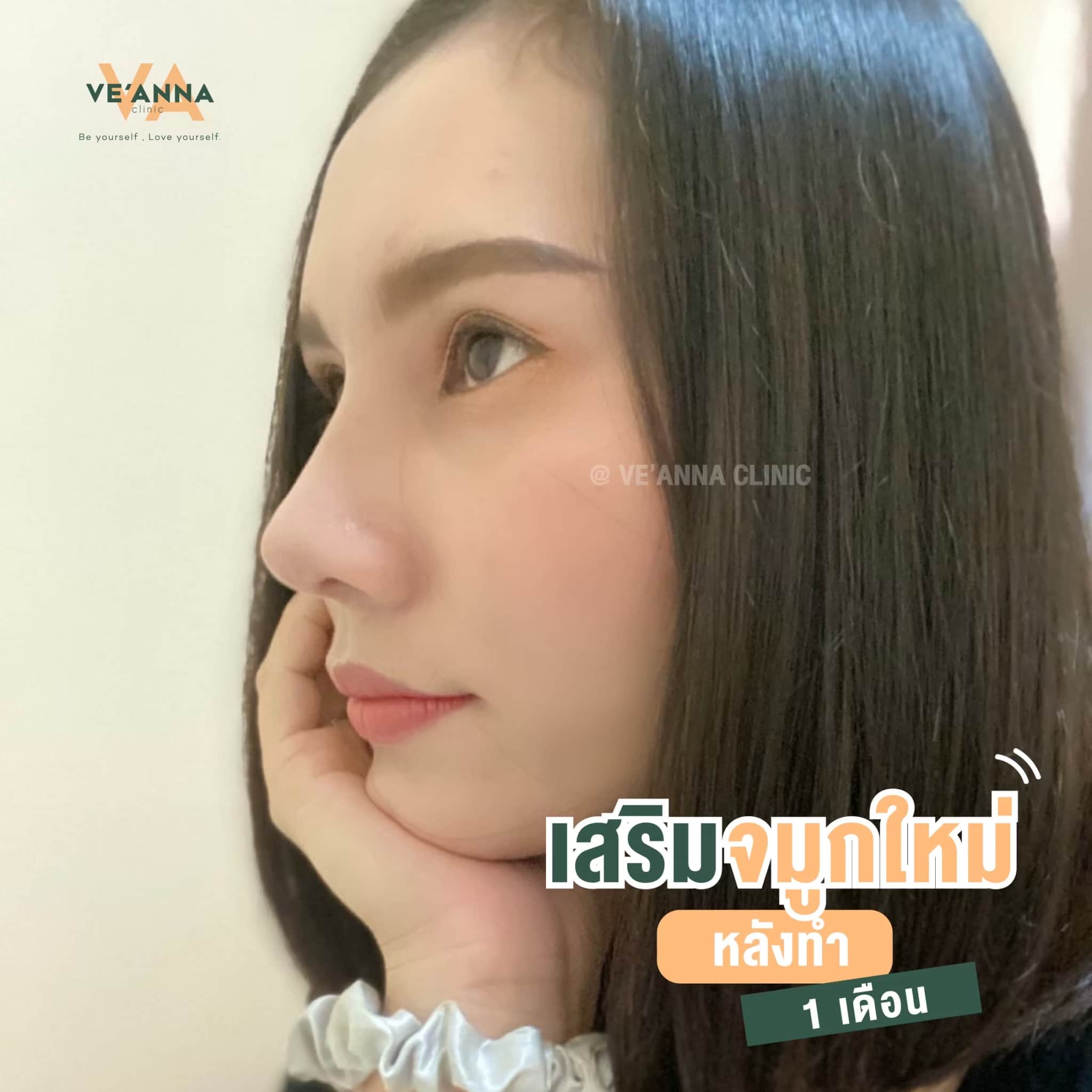 รีวิวการเสริมจมูก อินเตอร์โดม เนื้อเยื่อเทียม