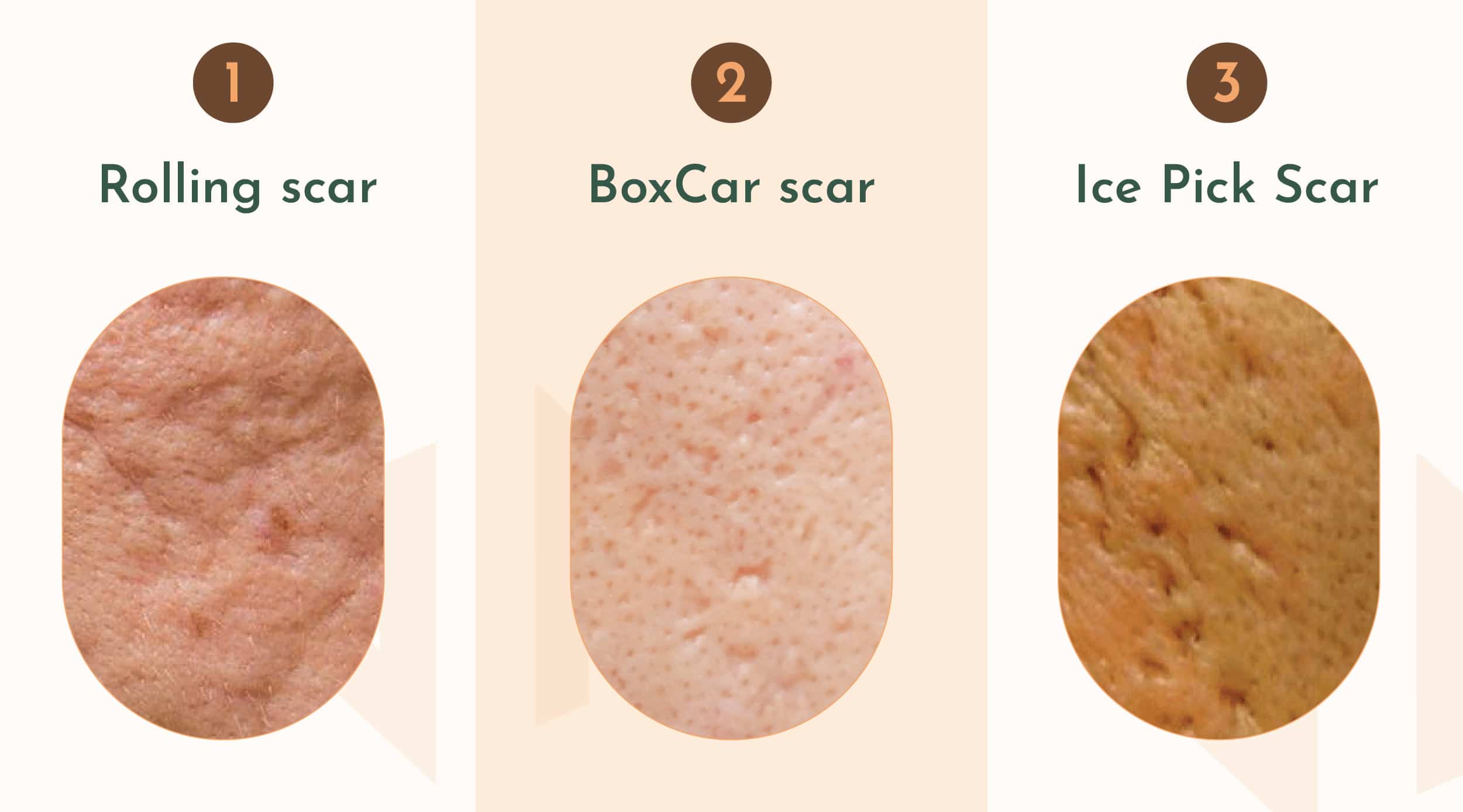รักษารอยหลุมสิว เปลี่ยนผิวให้เรียบเนียนด้วย เครื่องเลเซอร์ Venus Viva MD