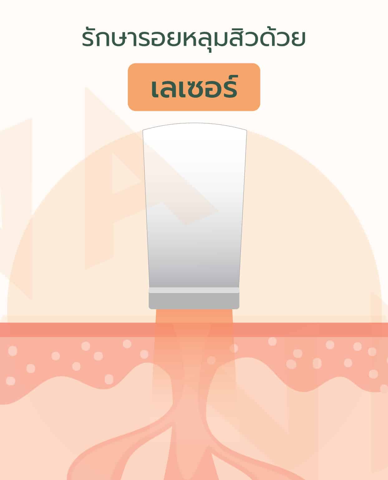 รักษารอยหลุมสิว เปลี่ยนผิวให้เรียบเนียนด้วย เครื่องเลเซอร์ Venus Viva MD