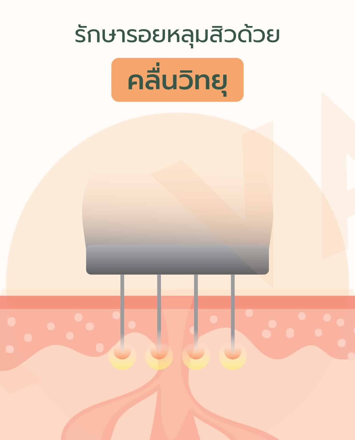 รักษารอยหลุมสิว เปลี่ยนผิวให้เรียบเนียนด้วย เครื่องเลเซอร์ Venus Viva MD