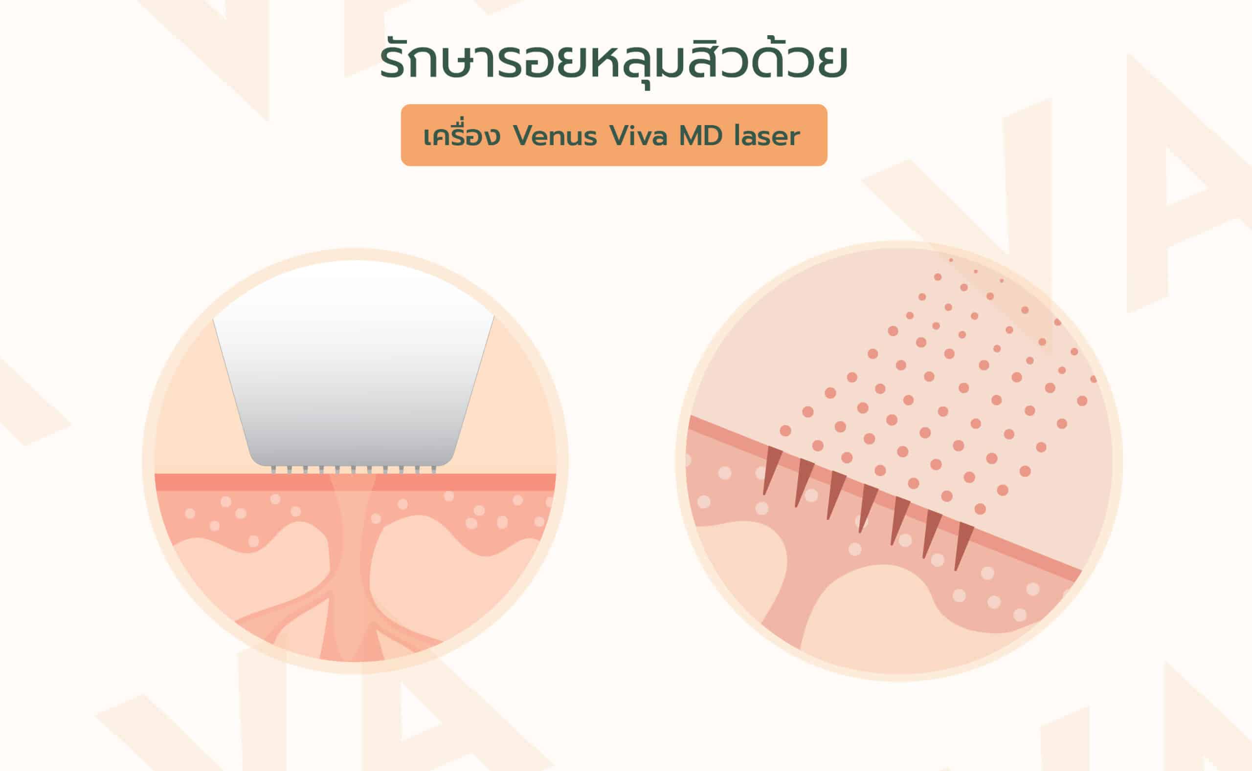 รักษารอยหลุมสิว เปลี่ยนผิวให้เรียบเนียนด้วย เครื่องเลเซอร์ Venus Viva MD